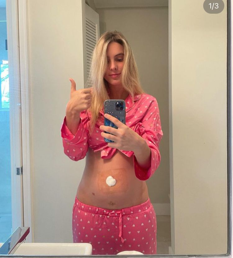 Lele Pons Kongsi Catatan Instagram Positif Badan Selepas Pembedahan Apendiks